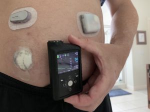 dexcom g6 with medtronic 670g