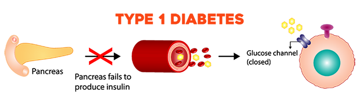 A diagram of type 1 diabetes, showing that the pancreas no longer produces insulin