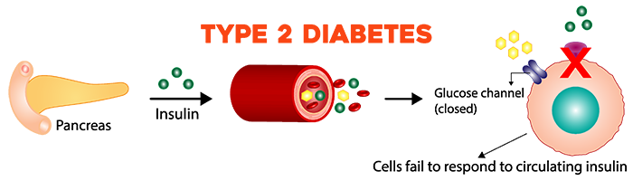 A diagram of type 2 diabetes, showing that the body experiences insulin resistance