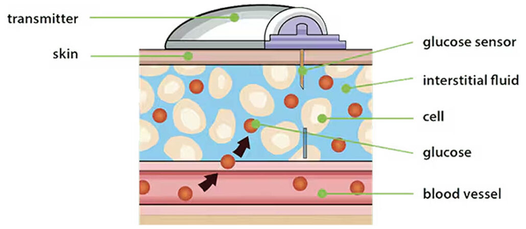 The difference between measuring glucose from capillary blood and measuring glucose from interstitial fluid via CGM sensor