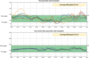 graph showing pre- and post islet cell transplant cgm data