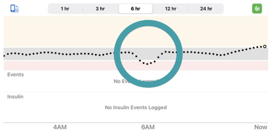 A CGM report shows an example of a compression low.