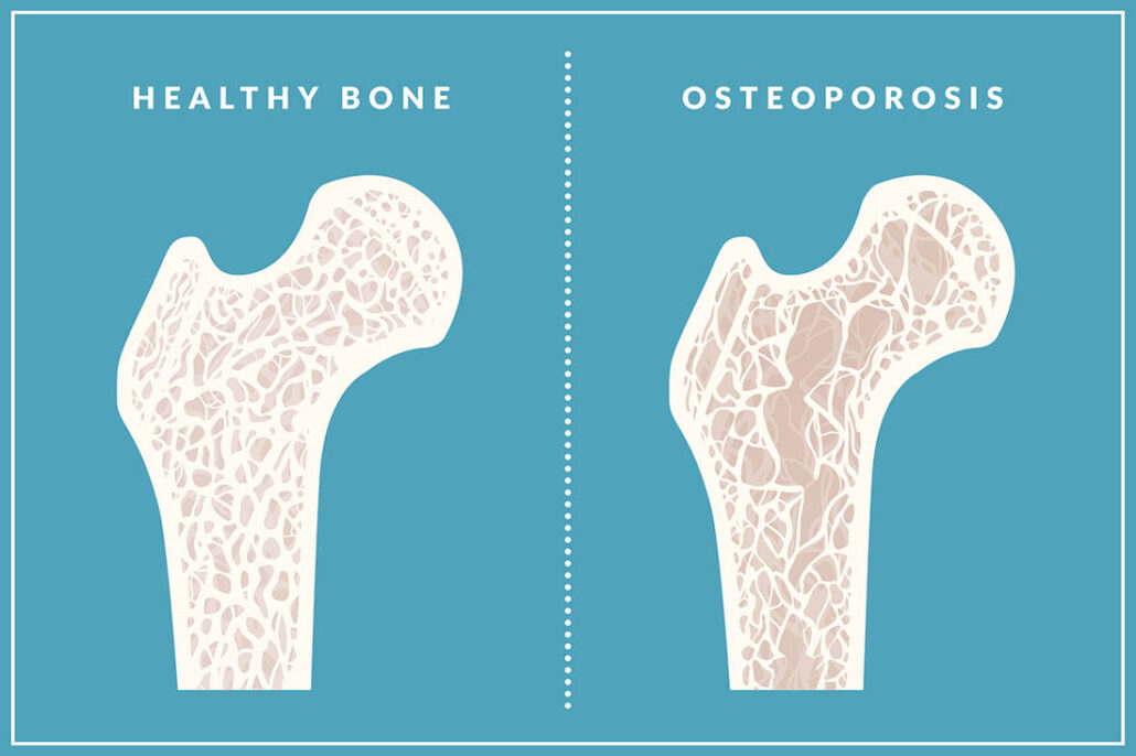 picture of healthy bone and bone with osteoporosis
