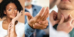 Three autoimmune conditions associated with type 1 diabetes: vitiligo, rheumatoid arthritis, and thyroid conditions