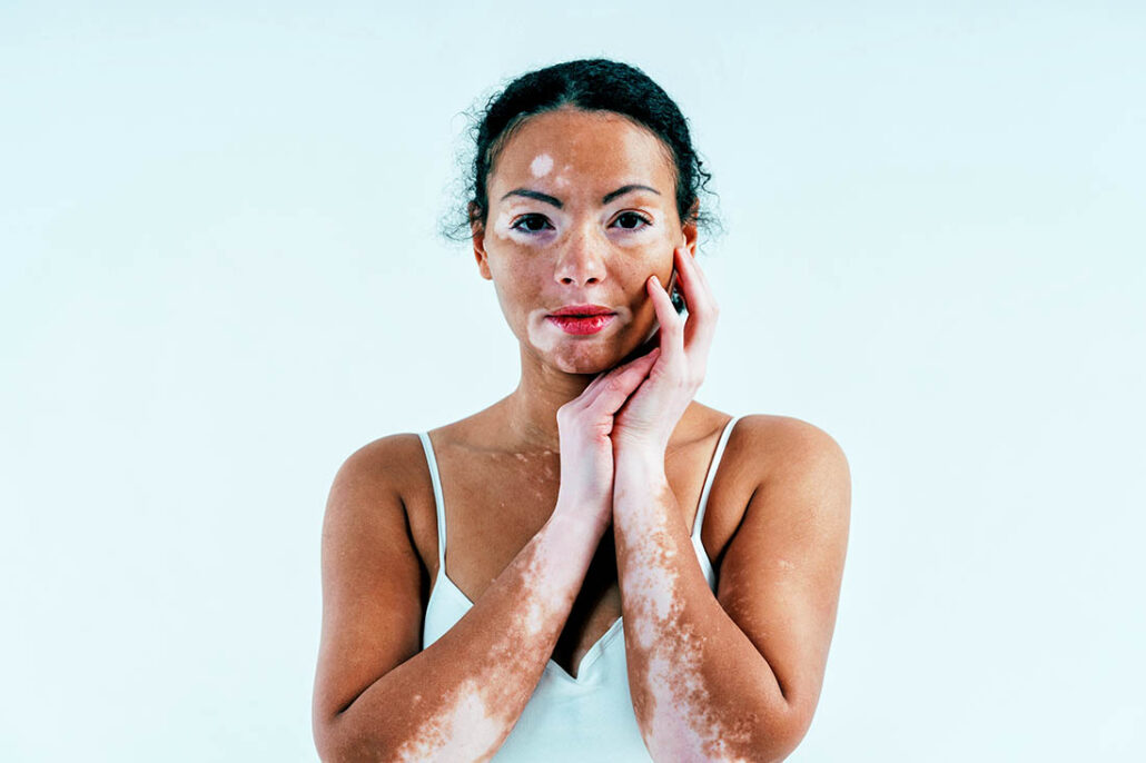 Woman with white patches on her skin as a result of vitiligo.