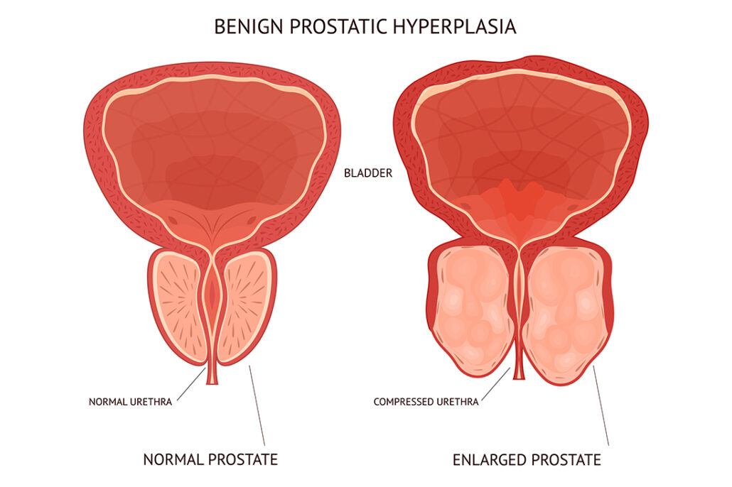 Graphic illustrating an enlarged prostate compared to a normal prostate
