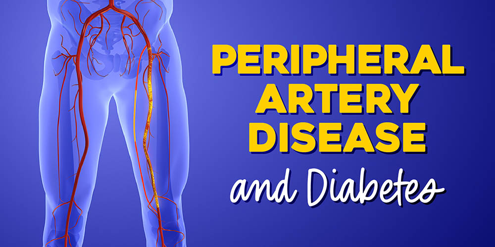 An anatomical illustration of a human lower body, focusing on the arterial system of the legs.