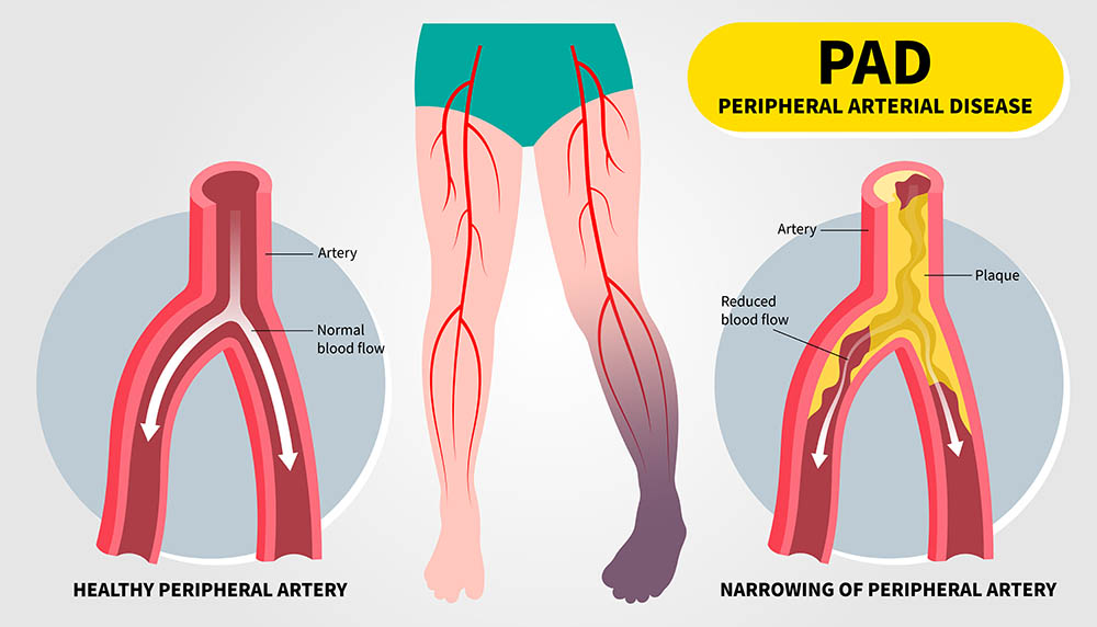 Is Your Blood Flow in Slow-Mo? What You Need to Know about PAD and Diabetes