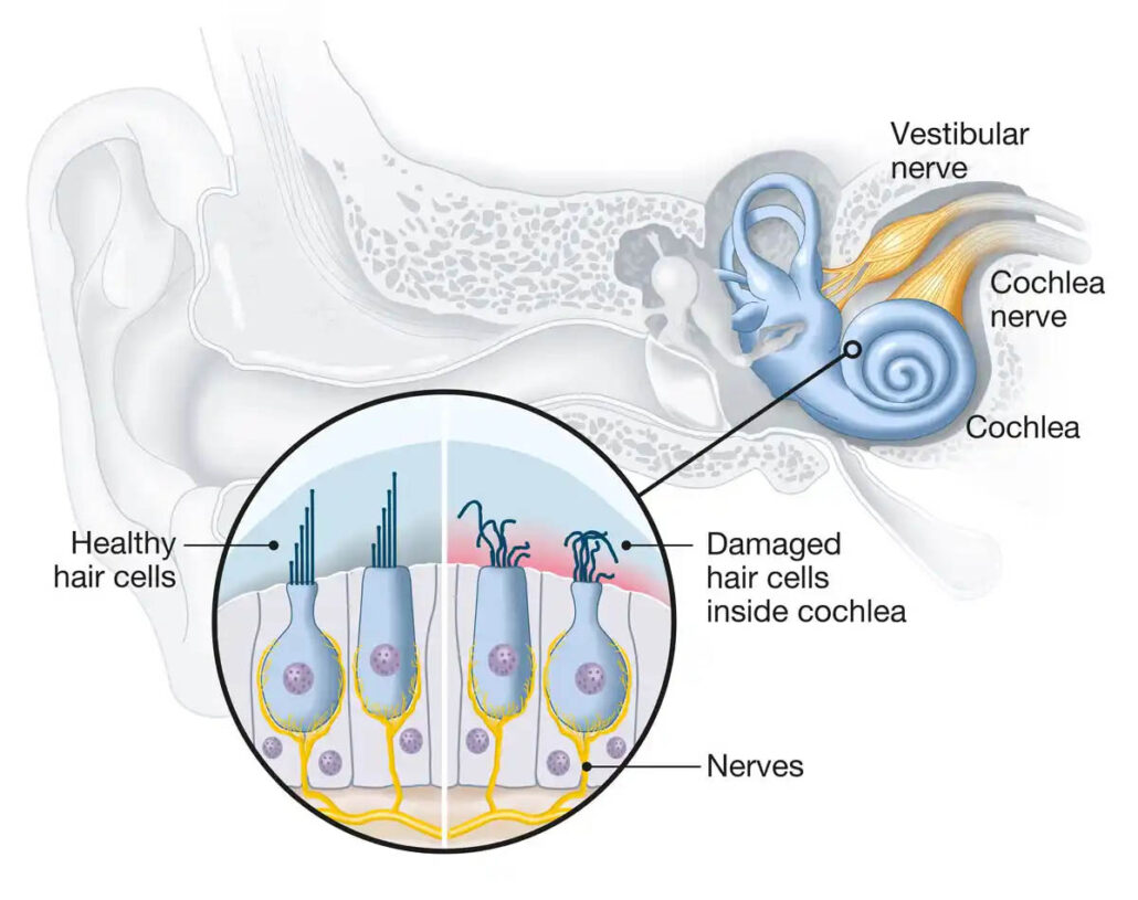 A diagram of the inner ear, including a picture of what damaged hair cells look like compared to health hair cells in the cochlea