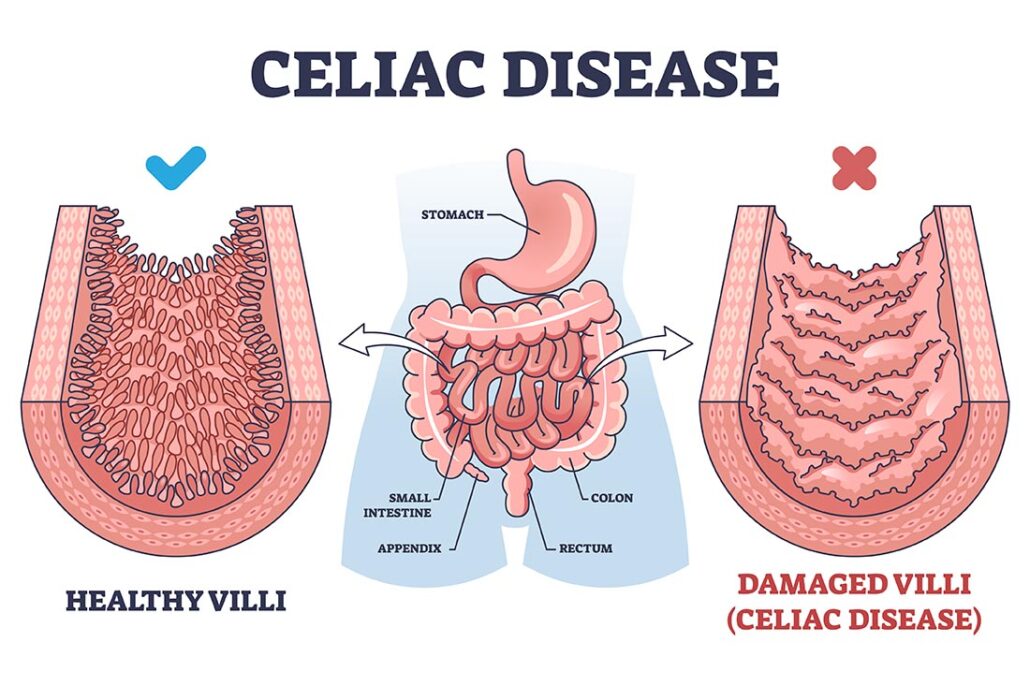 A small intestine showing healthy villi and damaged villi from celiac disease