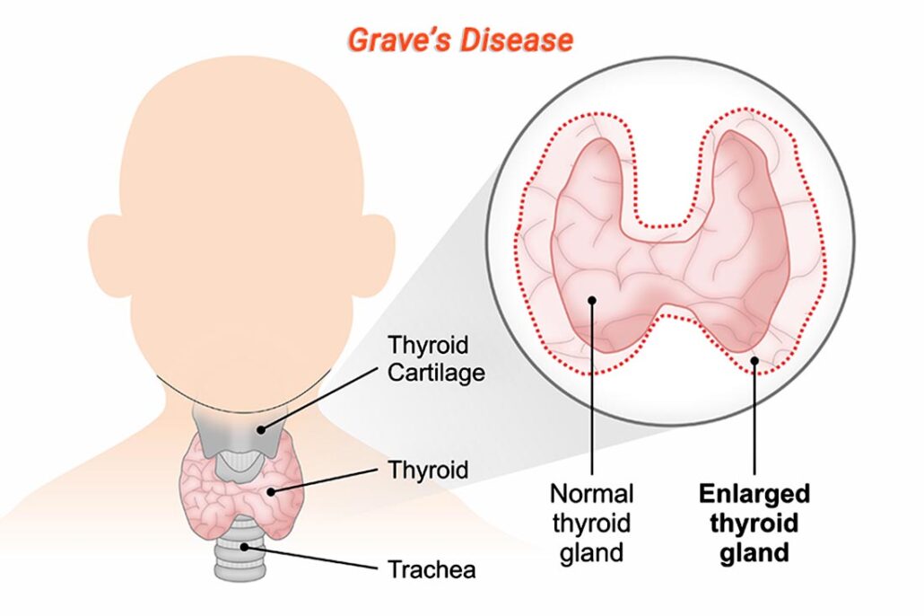 A normal thyroid gland compared to an enlarged thyroid gland which can happen with Graves' Disease