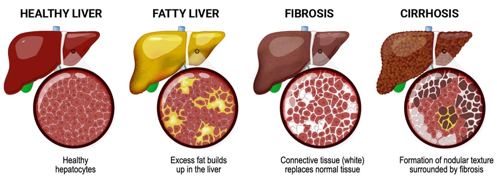 How the liver looks as it progresses through the stages of liver disease, including fatty liver, fibrosis, and cirrhosis